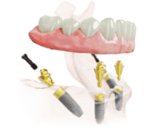 Схема имплантационной системы
