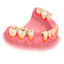 Изображение зубов при остром пародонтозе