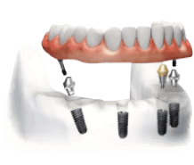 Схема имплантационной системы