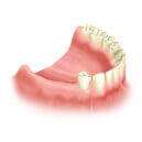 Изображение зубов при частичной адентии